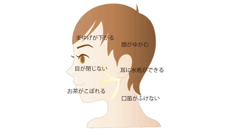 顔面神経麻痺に必要なこと