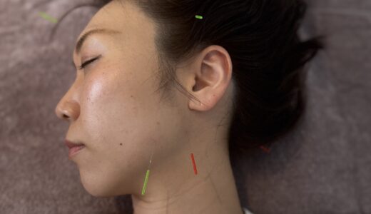 美容鍼日記 はじめます☀️