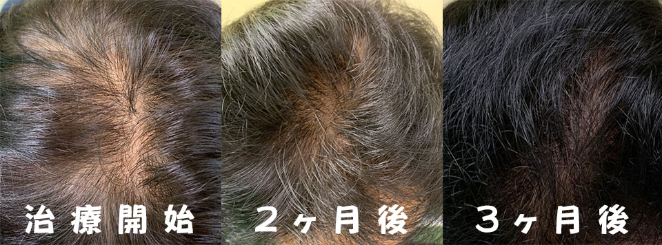 新城市の薄毛・脱毛に対する発毛外来